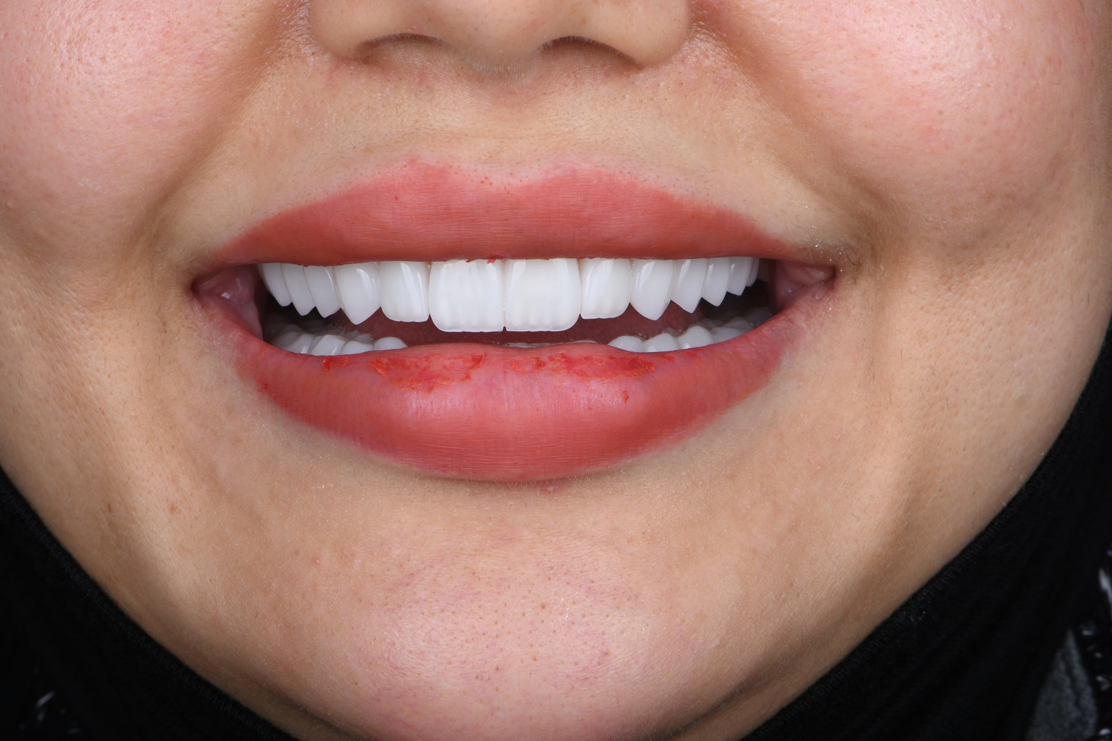 Completed smile
