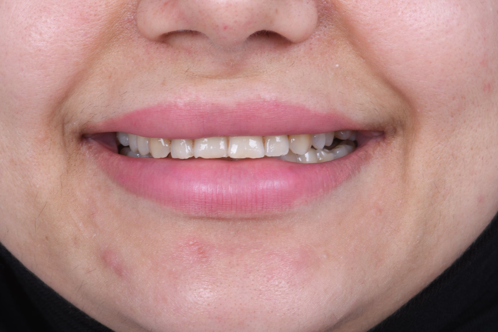 Before treatment — case 4