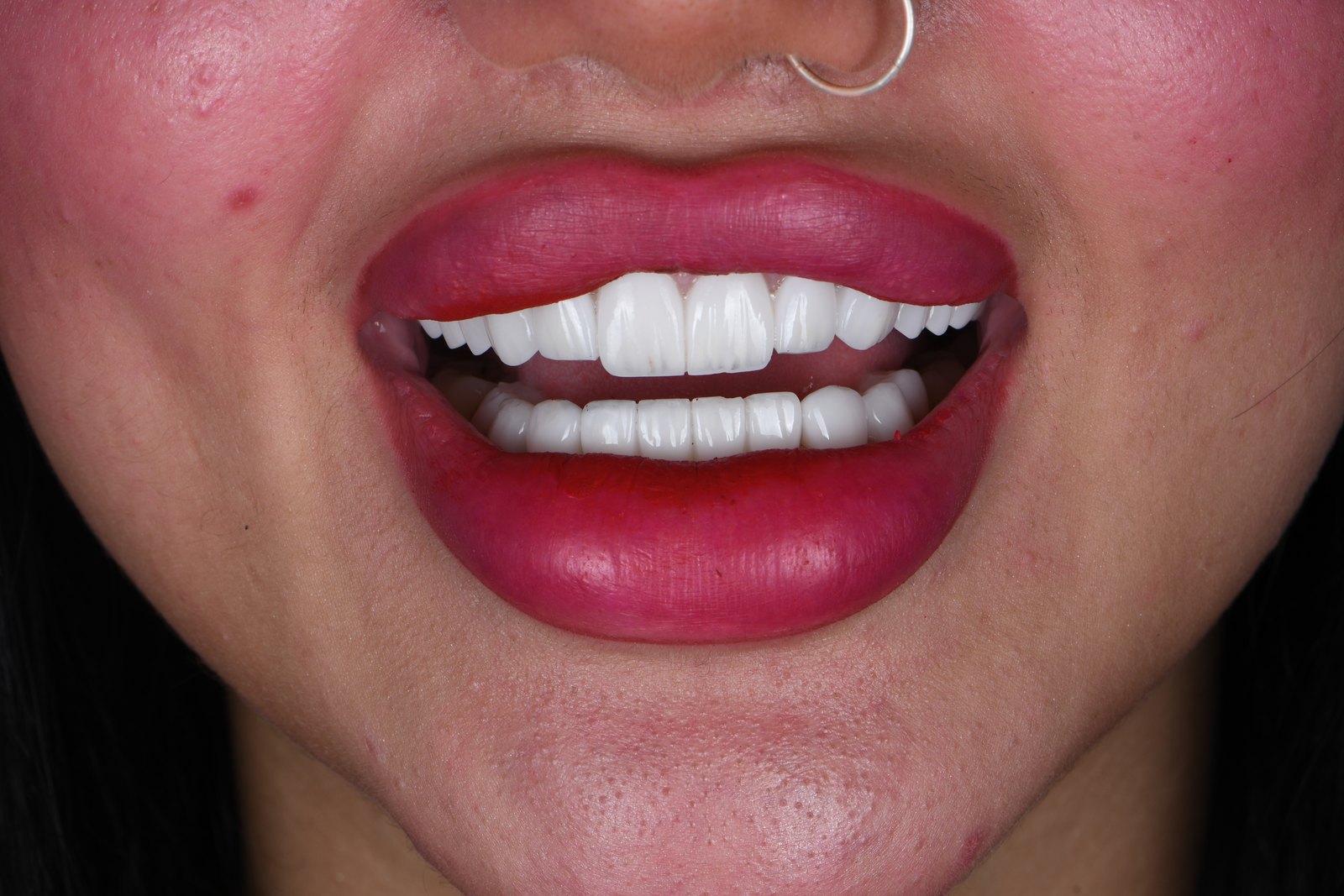 Completed smile