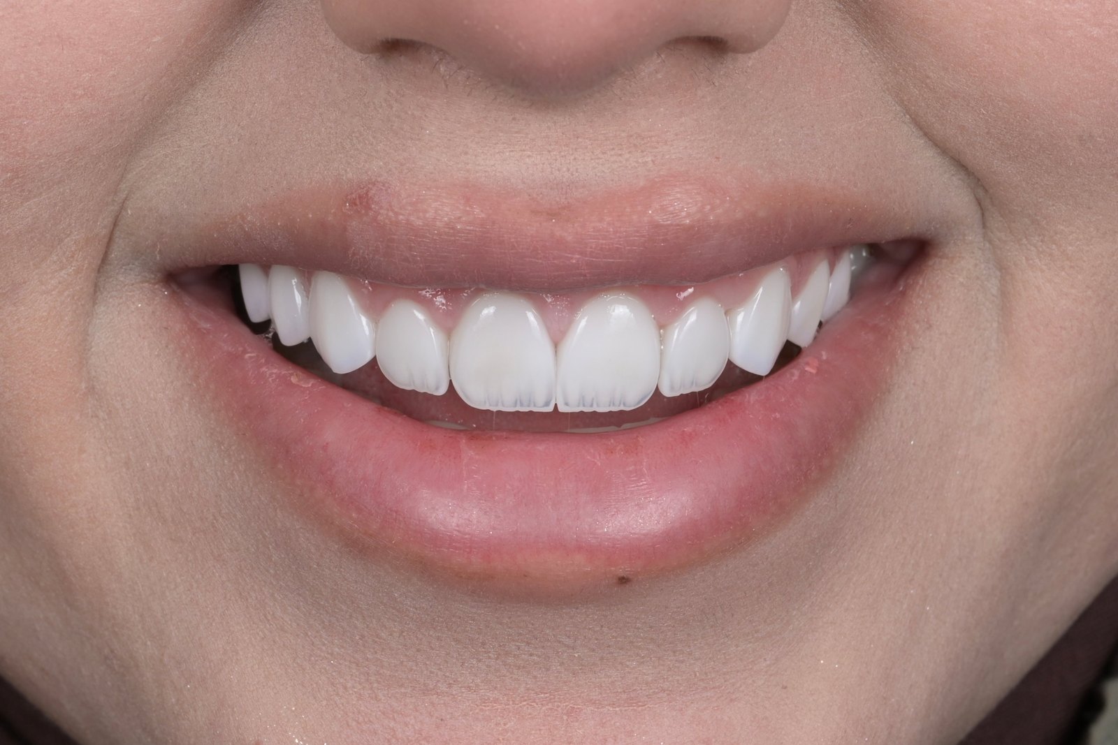 Completed smile